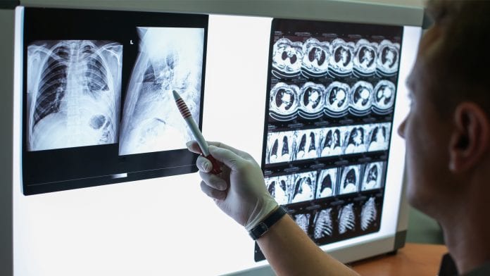 iStock-Egor Kulinich Let’s bear WITNESS to the ground-breaking Philippines TB modelling
