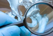 The treatment of severe postmenopausal osteoporosis The treatment of severe postmenopausal osteoporosis