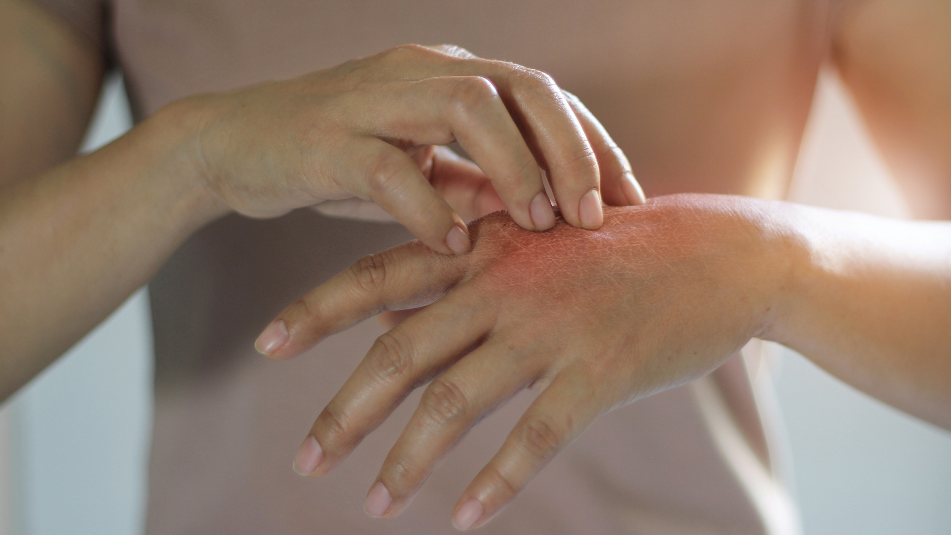 Chronically itchy skin: causation for depression, suicidal thoughts and stress?