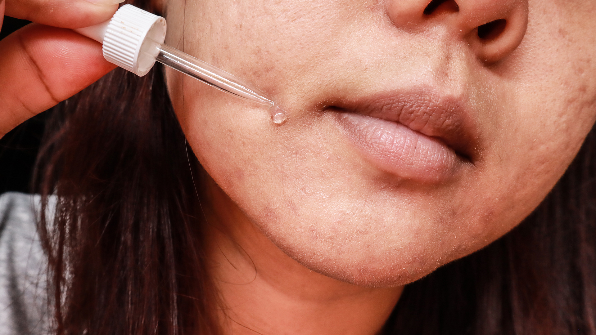 Investigating the effectiveness of a new cosmetic treatment for melasma