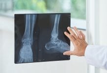 Bone healing mechanism could provide new therapeutic applications
