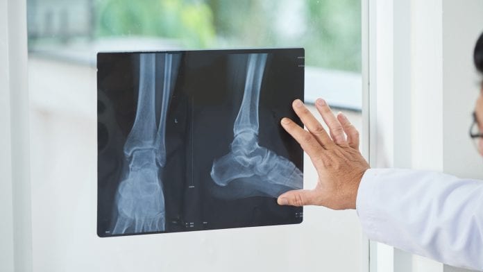 Bone healing mechanism could provide new therapeutic applications