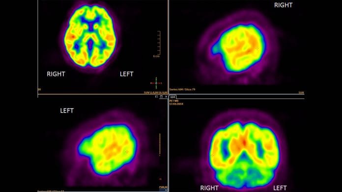 Research suggests a new breakthrough for drug resistant epilepsy 