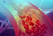 Can fat keep your arteries healthy? Cholesterol blocking artery. 3d illustration