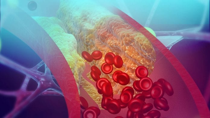 Cholesterol blocking artery. 3d illustration