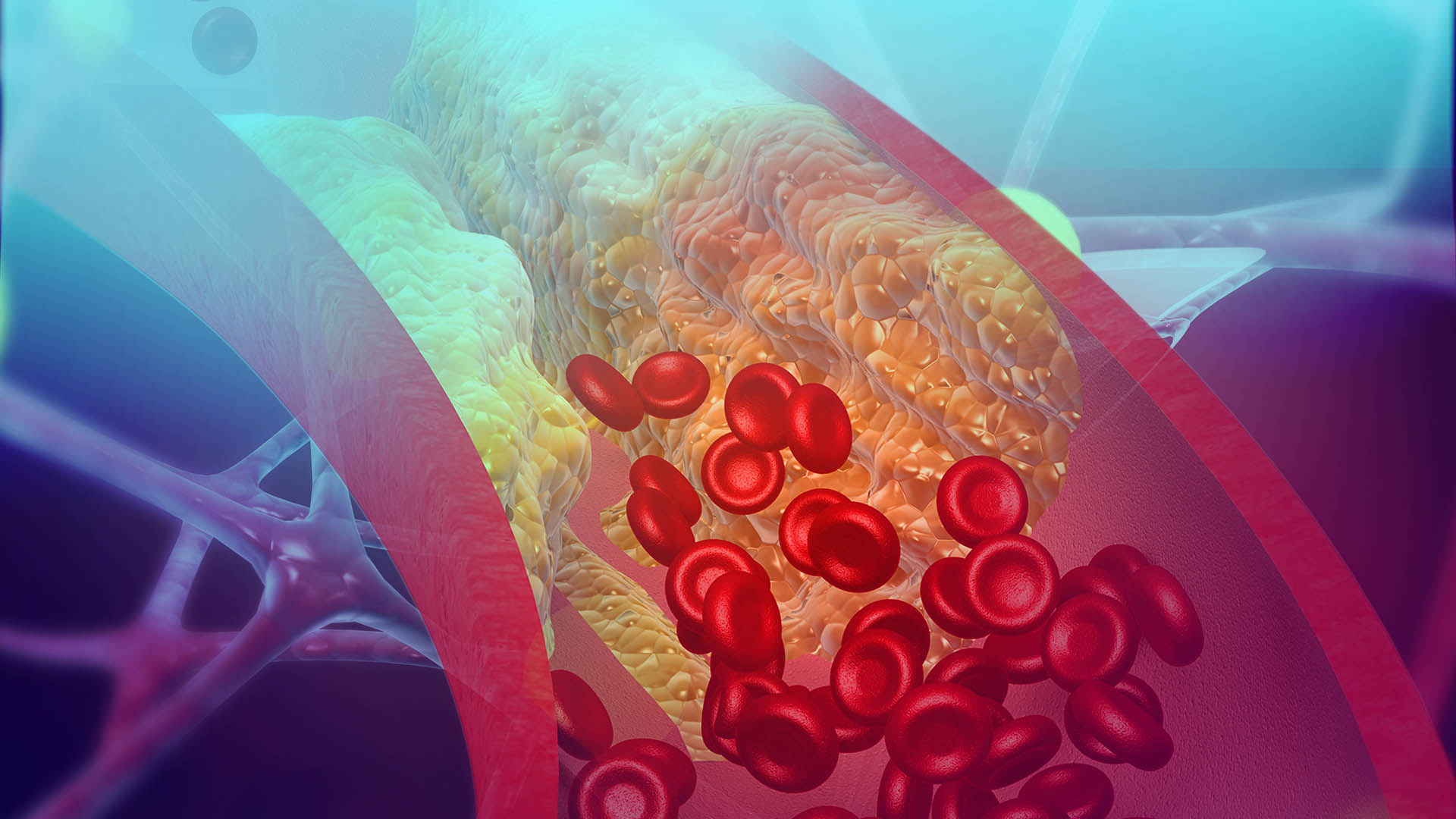 Cholesterol blocking artery. 3d illustration