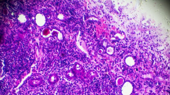 Sclerosing glomerulonephritis biopsy sample under microscopy stock photo