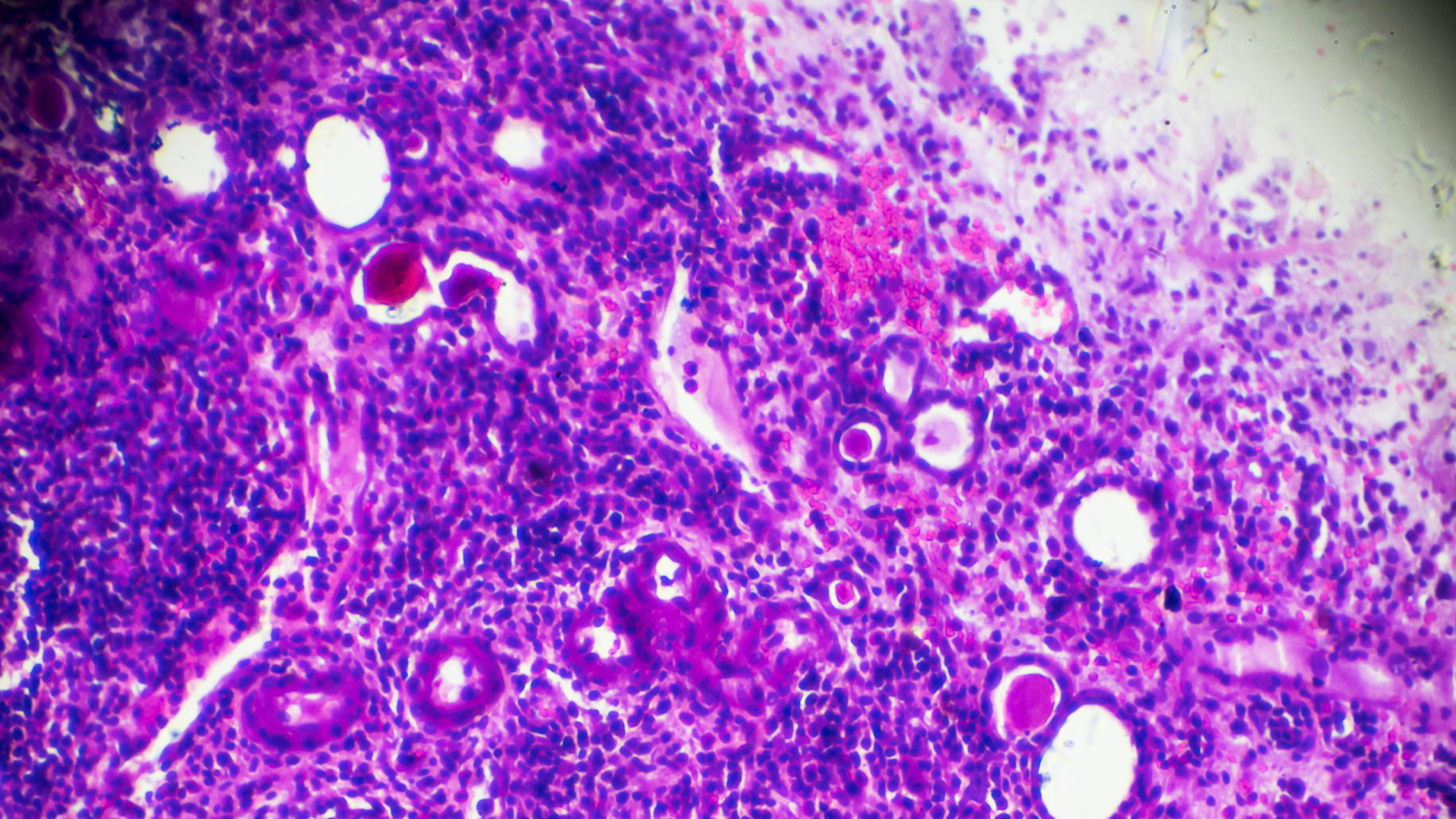 Sclerosing glomerulonephritis biopsy sample under microscopy stock photo