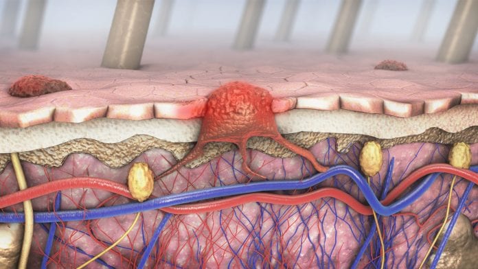 Skin cancer graphic of what happens under the skin