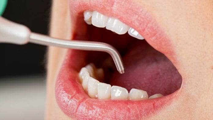 iStock-Ocskaymark Close up dental air flow treatment