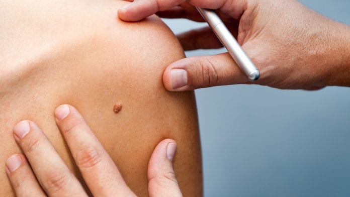 doctor reviewing patient with a melanoma