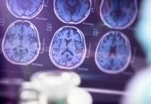 New imaging method sheds light on Alzheimer's disease