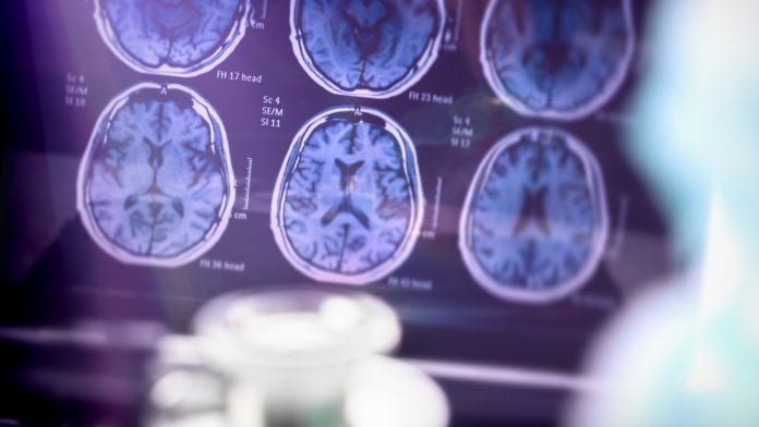 © iStock/digicomphoto New imaging method sheds light on Alzheimer's disease