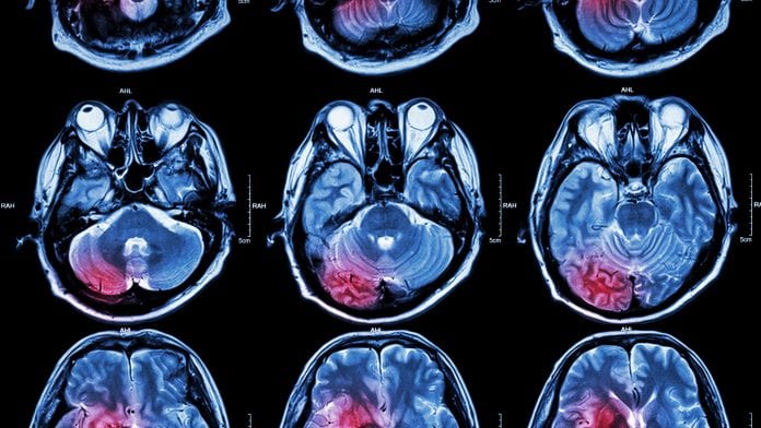 Brain inflammation may be linked to several different forms of dementia