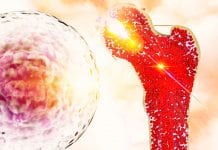 Kalytera Therapeutics: improving bone marrow transplants with CBD CBD: improving the odds of bone marrow transplant patients against GvHD