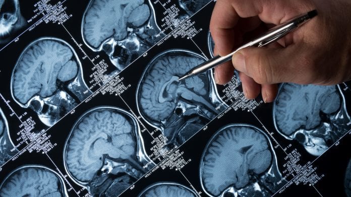 iStock-haydenbird Alzheimer's disease trial links high amyloid levels with early stage disease