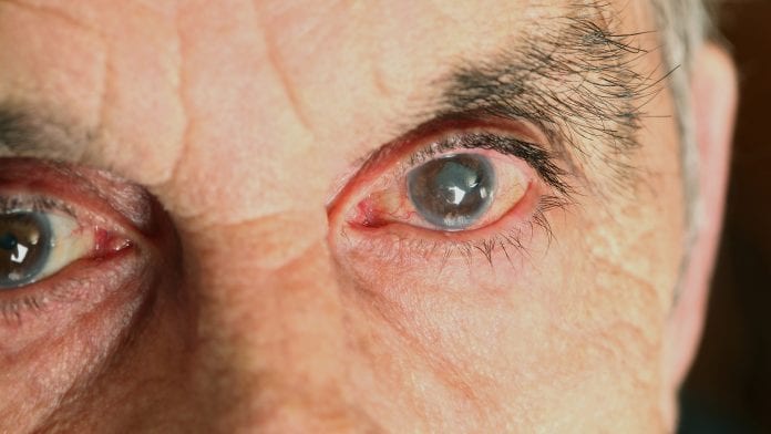 Discover how AI can help with early detection of glaucoma