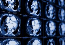 Teaching Artificial Intelligence to diagnose COVID-19 Teaching Artificial Intelligence to diagnose COVID-19