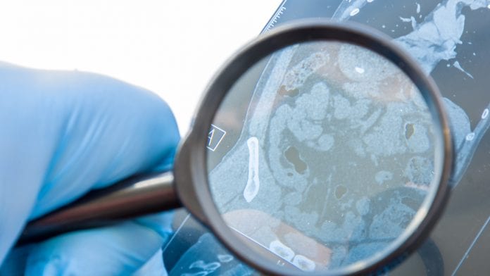 © iStock/Shidlovski CBD and inflammatory bowel disease: not just a gut feeling