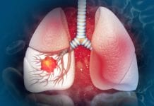 Lung cancers detected early as a result of pioneering trial lung cancer