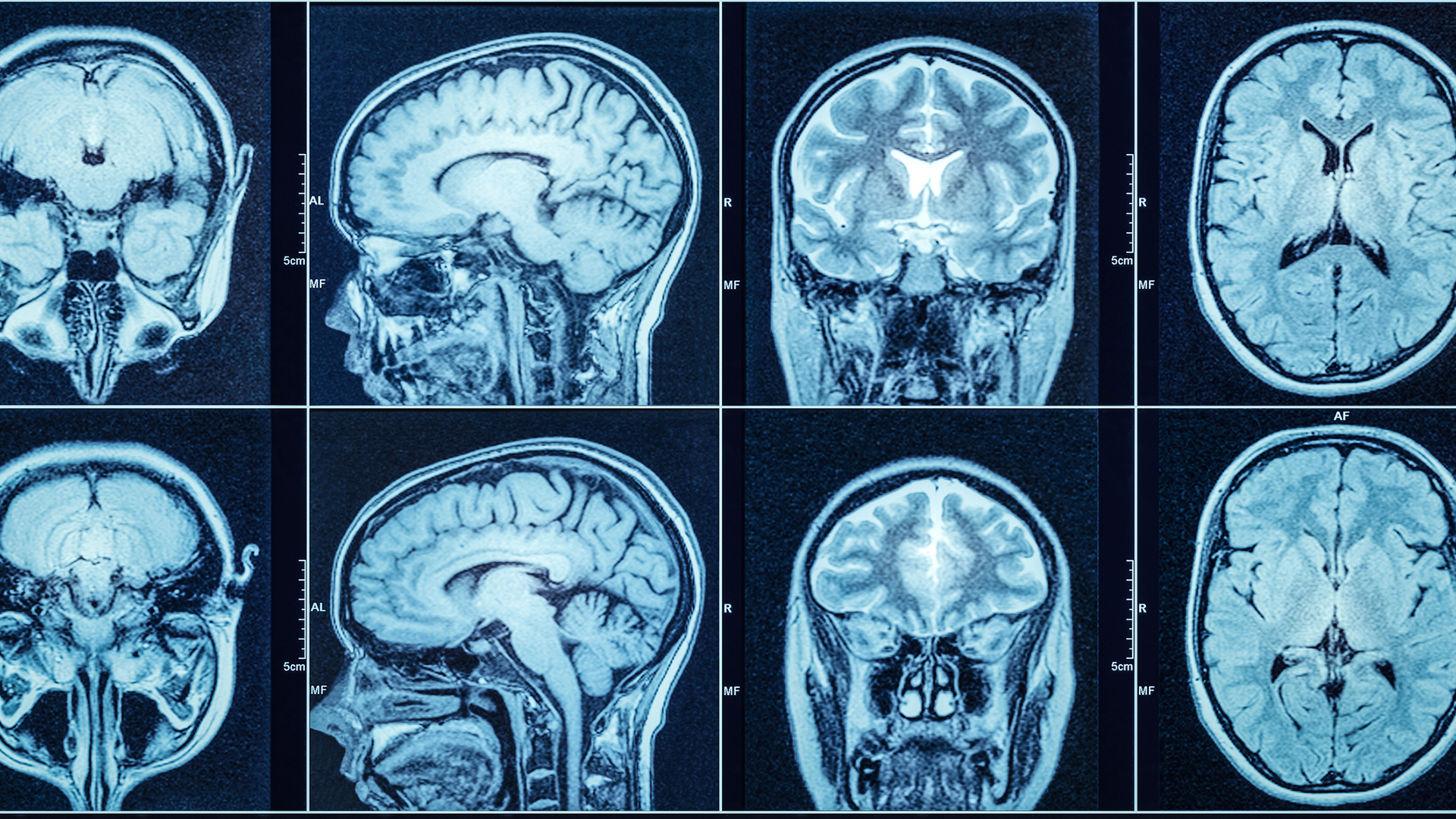Extending the reach of MRI with new portable brain imaging