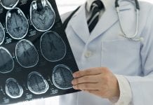 Trial shows positive results for reducing burden of stroke disability Trial shows positive results for reducing burden of stroke disability