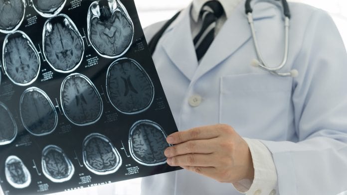 Trial shows positive results for reducing burden of stroke disability