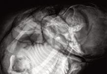 The mystery of stone babies: medical background about lithopaedions