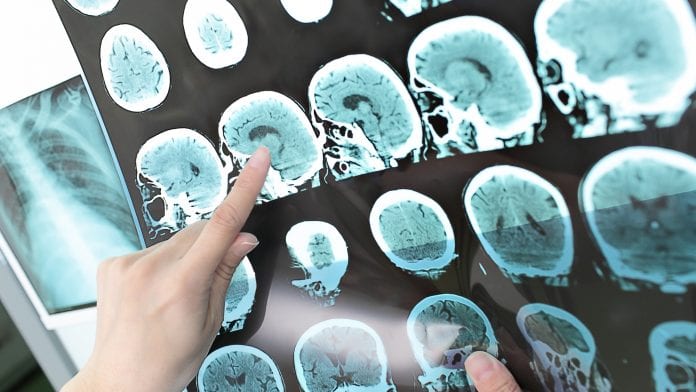 Research shows one in five people with multiple sclerosis now under 30