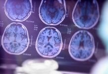 Less invasive method discovered for diagnosing potential for Alzheimer’s