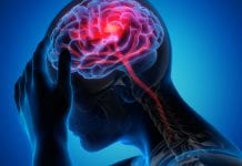 Innovation in stroke treatment Innovation in stroke treatment