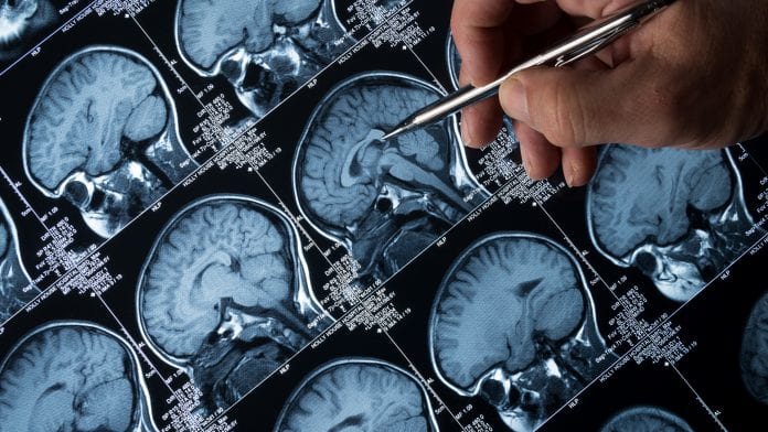 Cutting-edge nanotechnology could lead to Alzheimer’s disease test