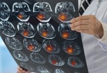 Breakthrough study finds clues for ‘silent’ stroke treatment
