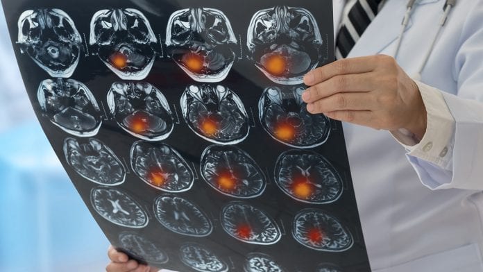 ©iStock/utah778 Breakthrough study finds clues for ‘silent’ stroke treatment