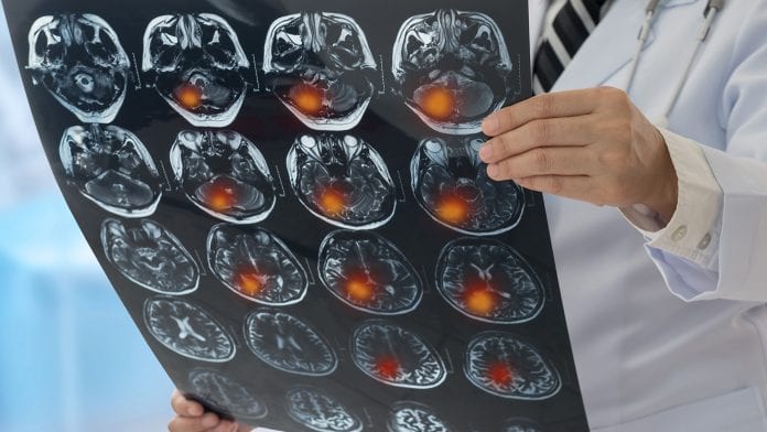 Breakthrough study finds clues for ‘silent’ stroke treatment