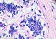 Predicting long-term outcomes for pre-invasive breast cancer Predicting long term outcomes for pre-invasive breast cancer