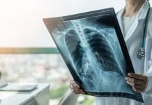 The first tumour-uninformed cancer DNA detection test tumour