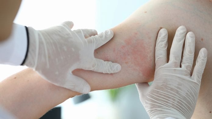 Gamechanger drug for psoriasis treatment offers hope for patients