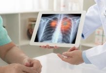 Lung cancer mortality influenced by pre-operative patient status lung cancer