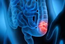 Correlation discovered between obesity-related colon cancer and inflammasomes colon cancer