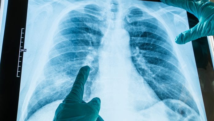 tuberculosis