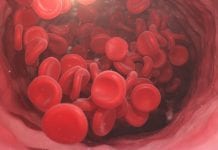 Revolutionising blood management for cancer surgery