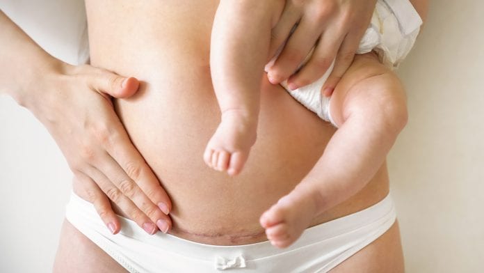 © iStock/Tatiana Dyuvbanova Study shows beneficial bacteria can be restored to C-section babies