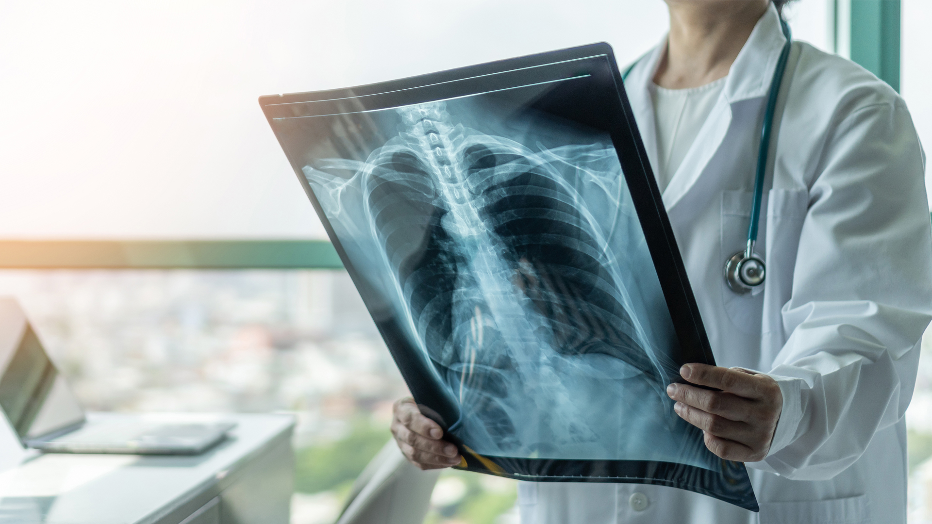 Reducing tuberculosis in England with a long-term action plan