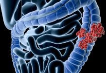 Colorectal cancer risk may be increased by low exposure to UVB light colorectal-cancer