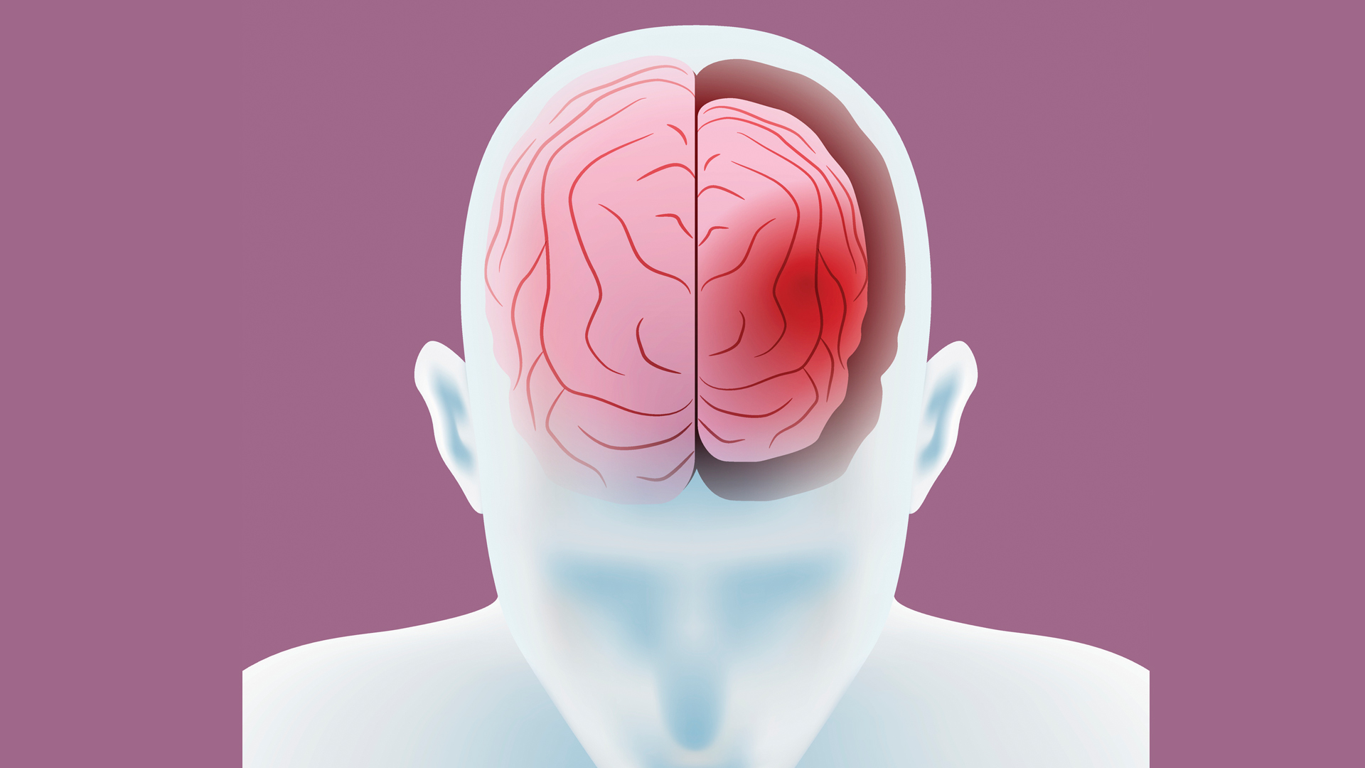 frontotemporal-dementia