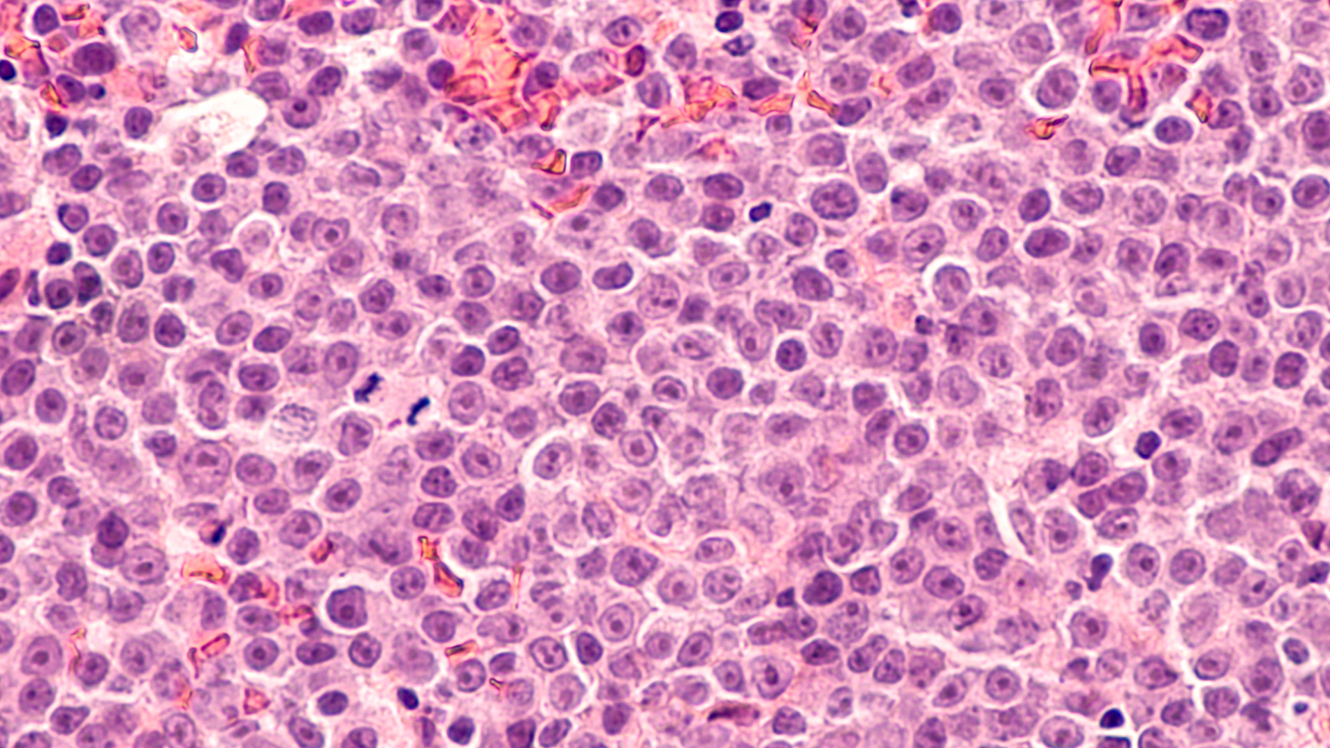 lymphomas
