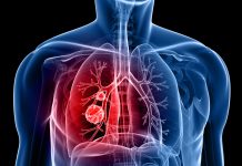 lung-cancer-AI