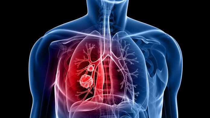 lung-cancer-AI