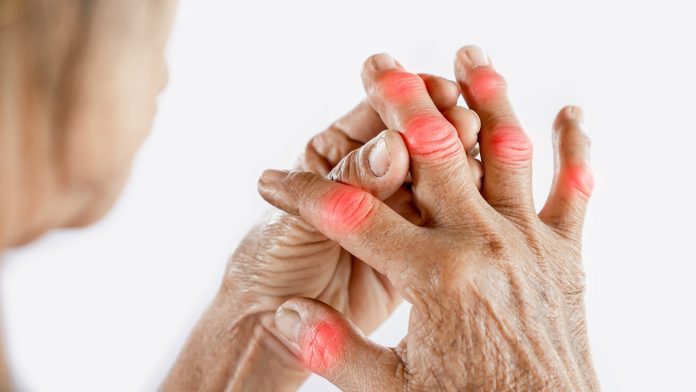 Asian woman hand suffering from joint pain with gout in finger inflammatory arthritis